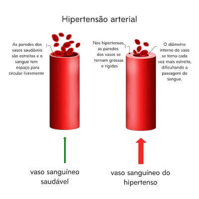 Ilustração mostrando a diferença entre artéria normal e artéria grossa, que causa a hipertensão.